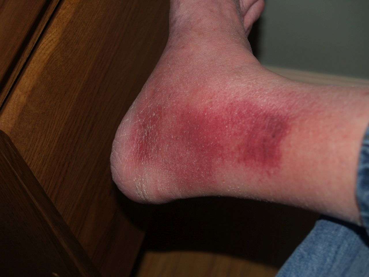 ankle spider bite.