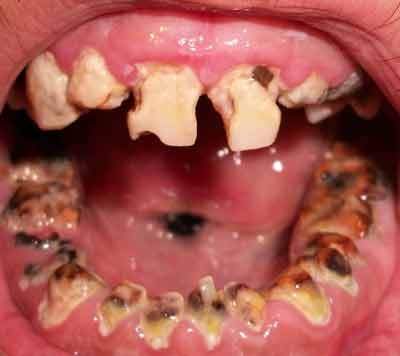 meth-teeth--teeth-with-advanced-tooth-decay.